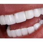 چه کسانی کاندید لمینت و کارهای زیبایی نیستند؟