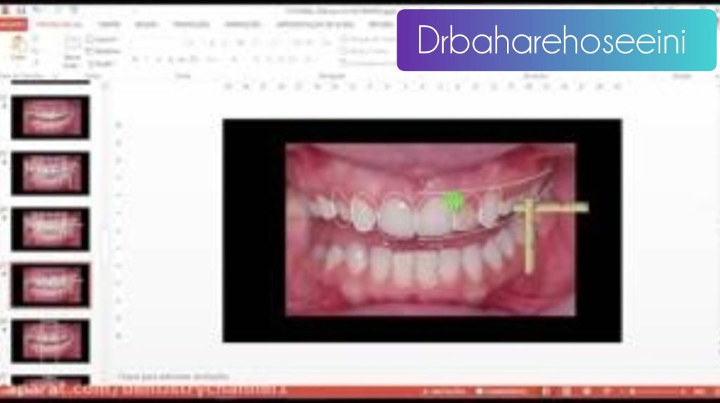 چگونگی طراحی لبخند دیجیتال و مراحل آن