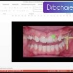 چگونگی طراحی لبخند دیجیتال و مراحل آن