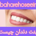مراحل لمینت دندان و نکات کلیدی