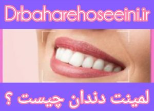 مراحل لمینت دندان و نکات کلیدی