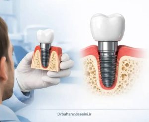 چند ماه بعد از جراحی ایمپلنت میتوان روکش دائم دریافت کرد
