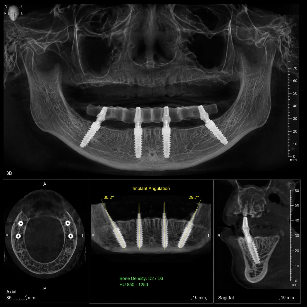 رادیوگرافی CBCT جراحی ایمپلنت All-on-4 و بررسی دقیق تراکم استخوان فک